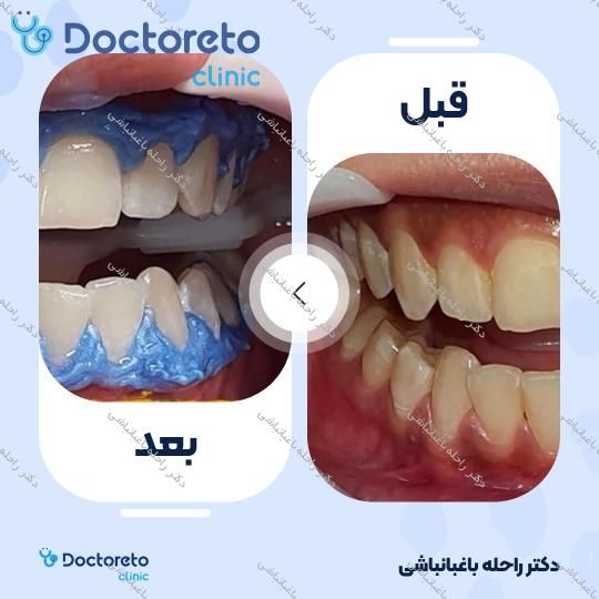 بلیچینگ دندان