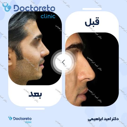 عمل جراحی مجدد زیبایی بینی (رینوپلاستی)