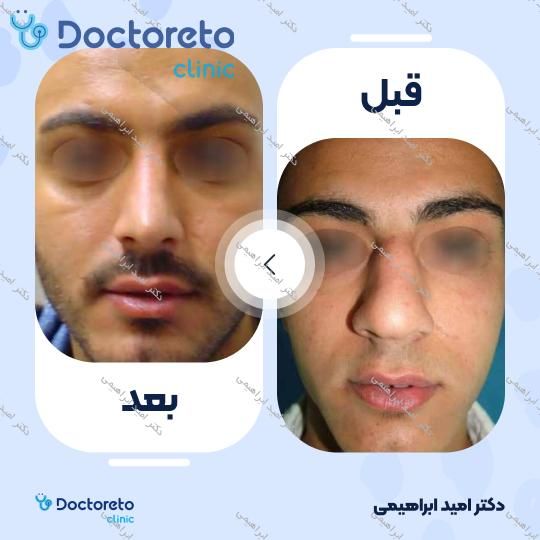 عمل جراحی مجدد زیبایی بینی (رینوپلاستی)
