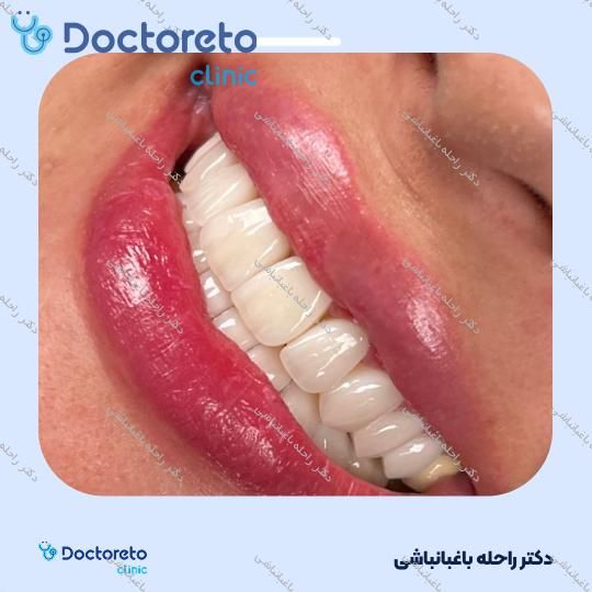 لمینت دندان (هر واحد)