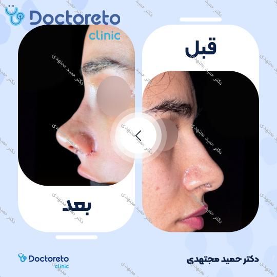 جراحی بینی ترمیمی