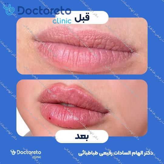 تزریق ژل صورت