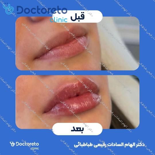 تزریق ژل صورت