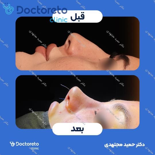 جراحی زیبایی بینی