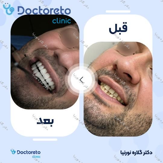 لمینت سرامیکی دندان IPS (هر واحد)