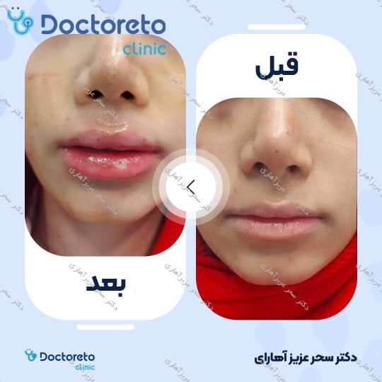تزریق ژل لب