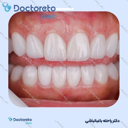 لمینت دندان (هر واحد)