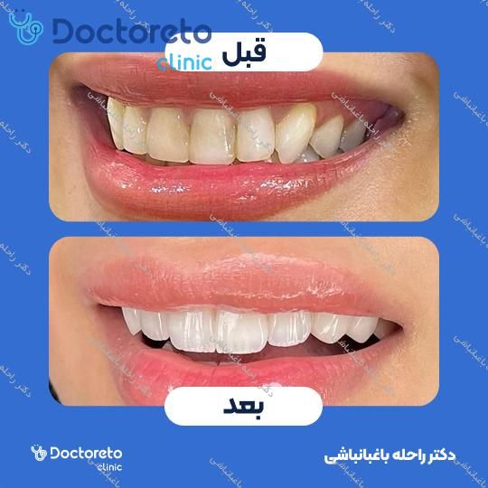 لمینت دندان (هر واحد)