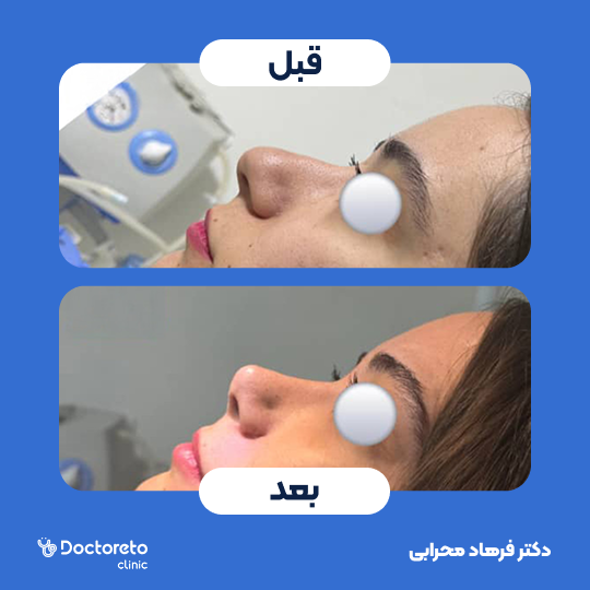 عمل زیبایی بینی (رینوپلاستی)