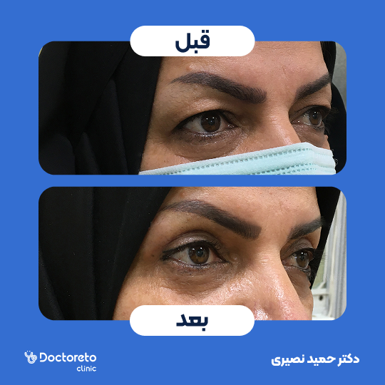 جراحی بلفاروپلاستی پلک بالا
