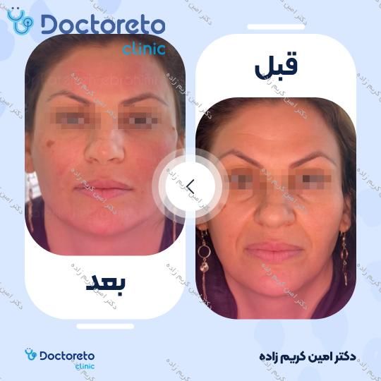 تزریق ژل صورت