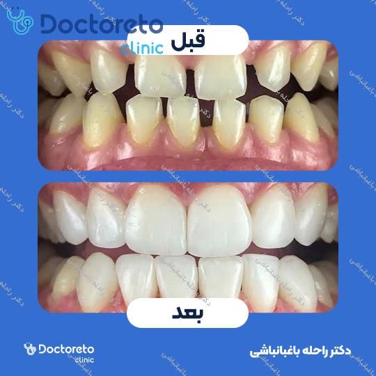ونیر کامپوزیت (هر واحد)