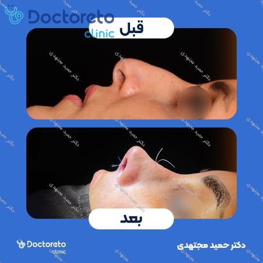 جراحی بینی ترمیمی