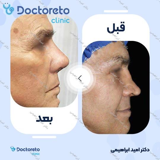 عمل جراحی مجدد زیبایی بینی (رینوپلاستی)