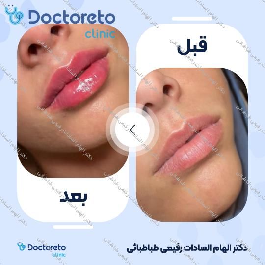 تزریق ژل صورت