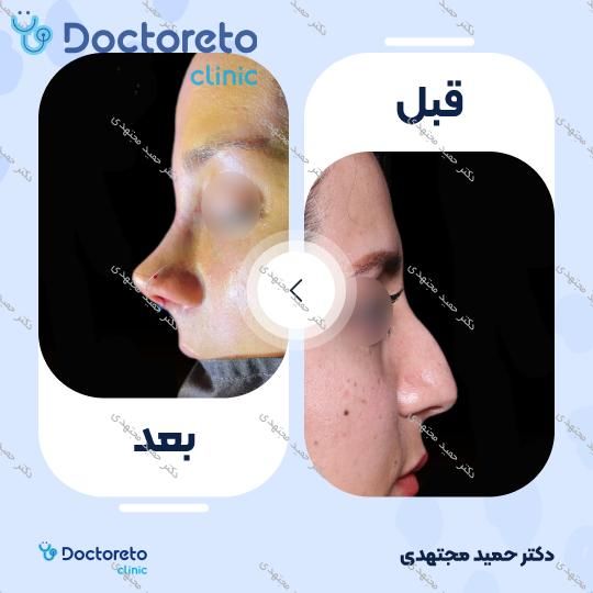 جراحی زیبایی بینی