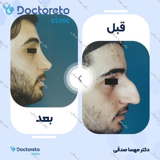 عمل زیبایی مجدد بینی