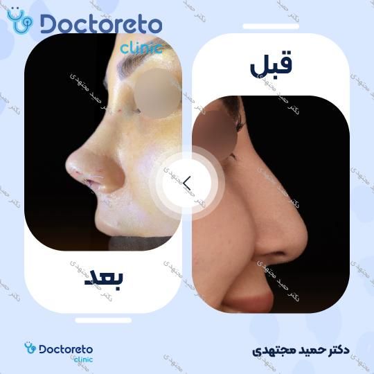 جراحی زیبایی بینی