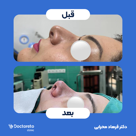 عمل زیبایی بینی (رینوپلاستی)