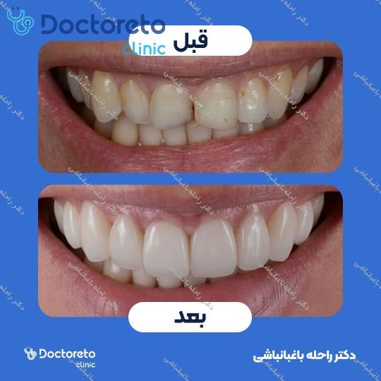 ونیر کامپوزیت (هر واحد)