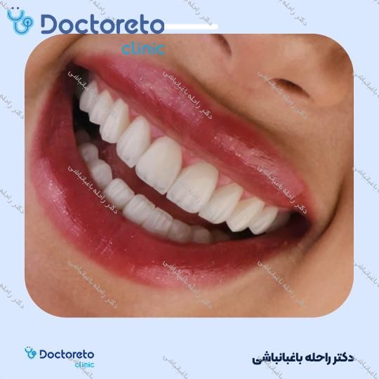 لمینت دندان (هر واحد)