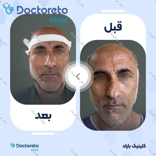 نمونه های کاشت مو