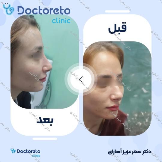 جوانسازی صورت (فول فیس) به روش تزریق چربی