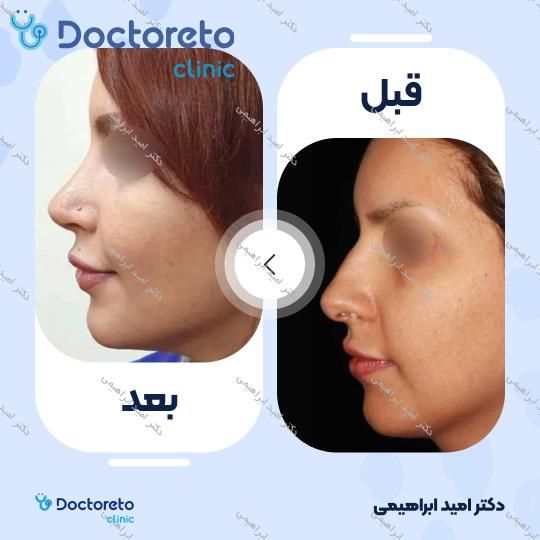 عمل جراحی مجدد زیبایی بینی (رینوپلاستی)