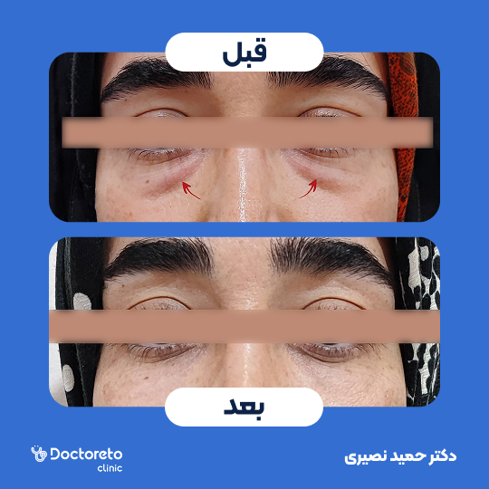رفع افتادگی پلک پایین به روش خارج پلکی (بلفاروپلاستی)