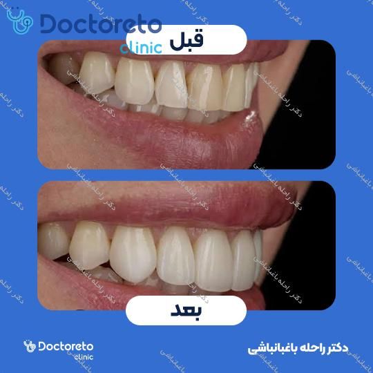 ونیر کامپوزیت (هر واحد)
