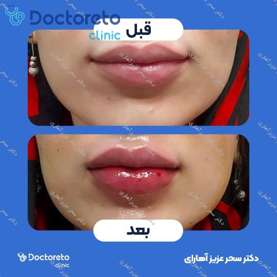 تزریق ژل لب