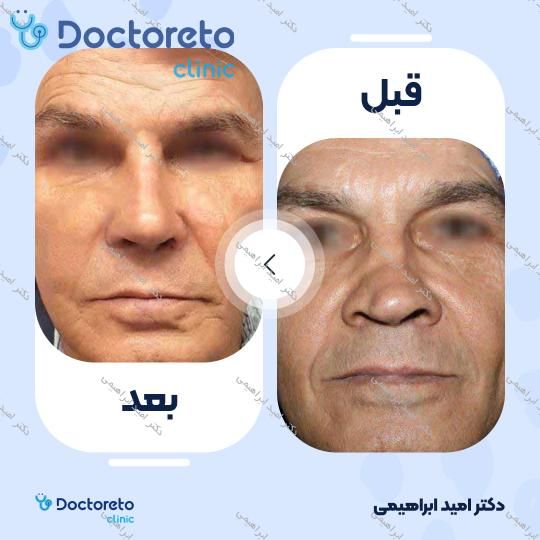 عمل جراحی مجدد زیبایی بینی (رینوپلاستی)