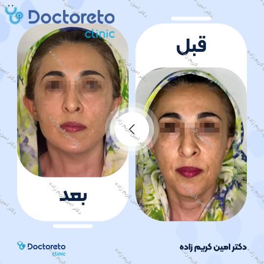 تزریق ژل صورت
