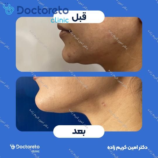 عمل لیپوساکشن غبغب