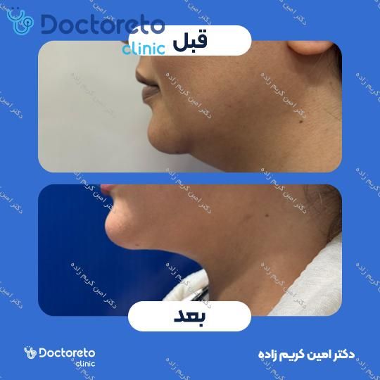 عمل لیپوساکشن غبغب
