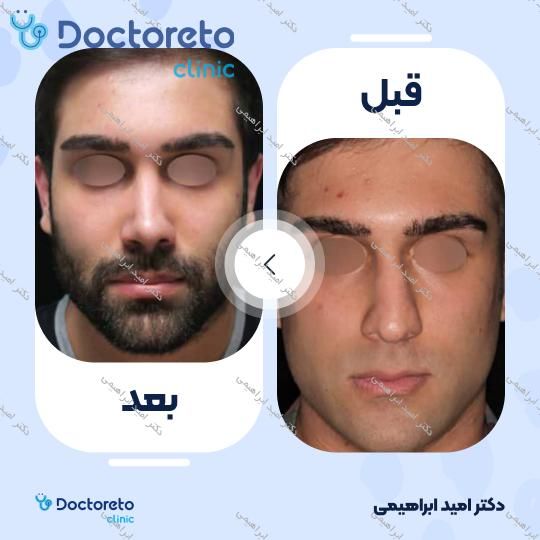 عمل جراحی مجدد زیبایی بینی (رینوپلاستی)
