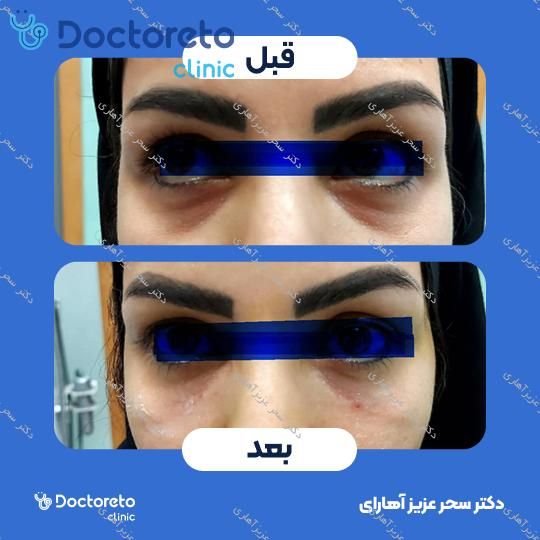 تزریق ژل زیر چشم
