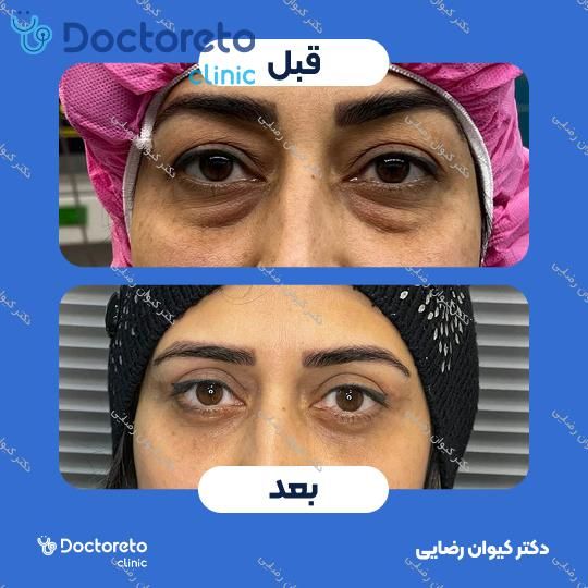 رفع افتادگی پلک (بلفاروپلاستی)