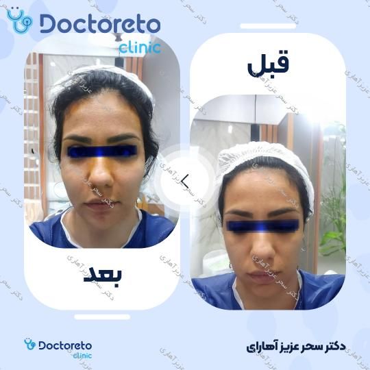 جوانسازی صورت (فول فیس) به روش تزریق چربی