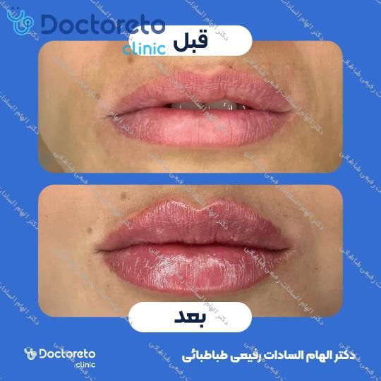 تزریق ژل صورت