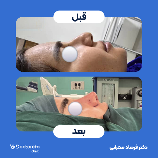 عمل زیبایی بینی (رینوپلاستی)