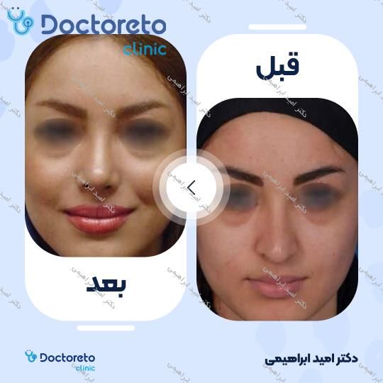عمل جراحی مجدد زیبایی بینی (رینوپلاستی)