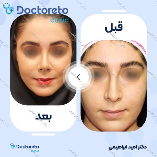 عمل جراحی مجدد زیبایی بینی (رینوپلاستی)