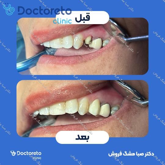 روکش دندان (هر واحد)⬅️ دکتر صبا مشگ فروش در اصفهان 1