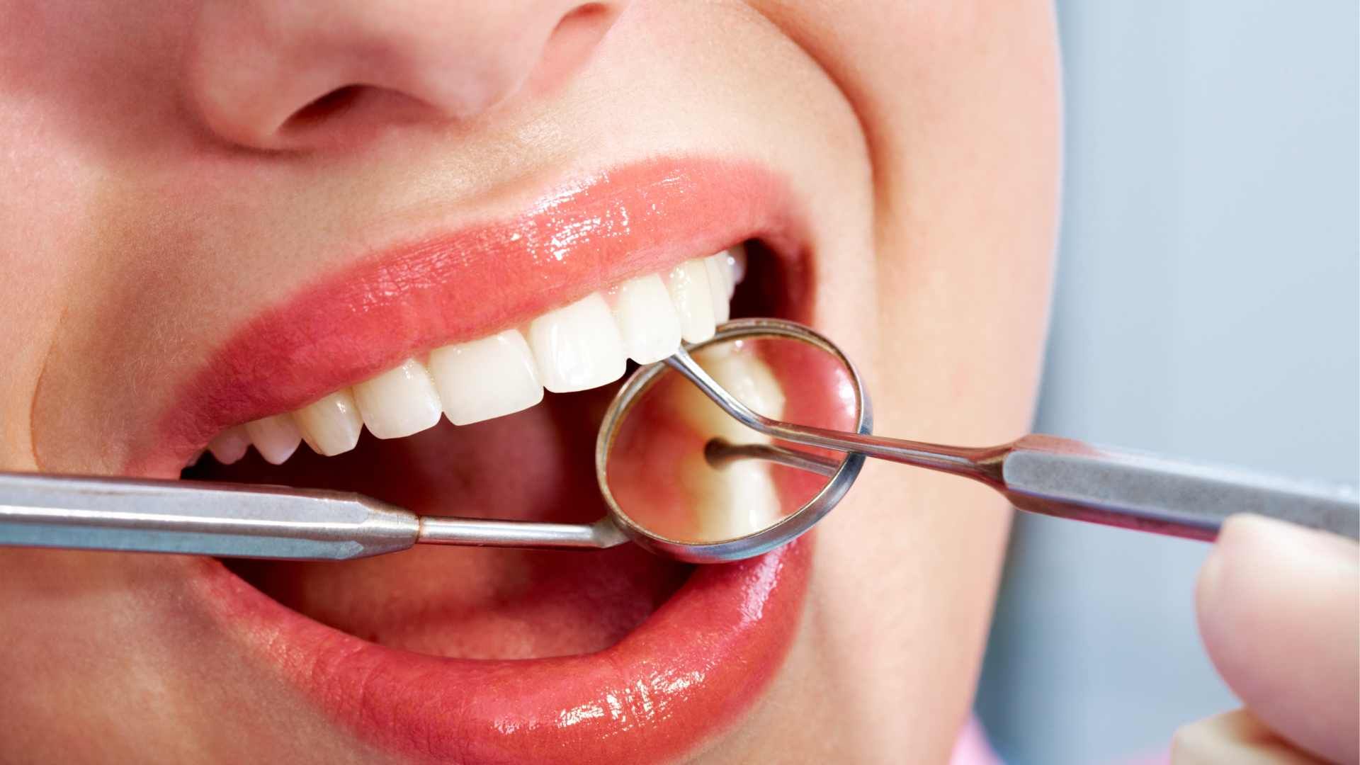 ونیر کامپوزیت (هر واحد)⬅️ دکتر پریسا دهقانی در تهران 1