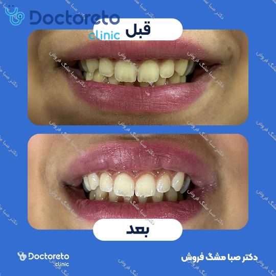 بلیچینگ دندان (سفید کردن دندان) دکتر صبا مشگ فروش در اصفهان 1