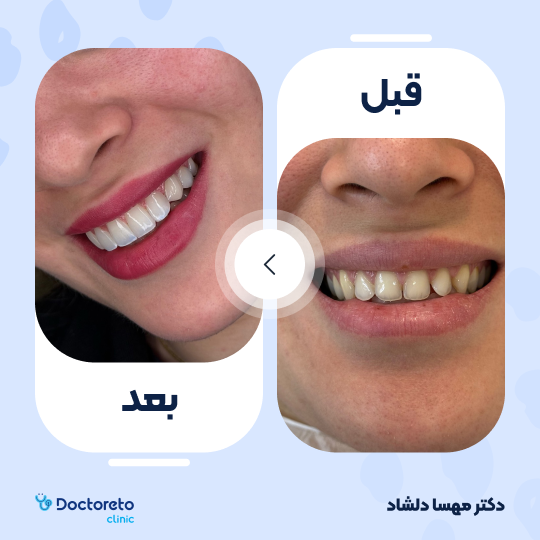 روکش دندان (هر واحد)⬅️ دکتر مهسا دلشاد در کرج 1