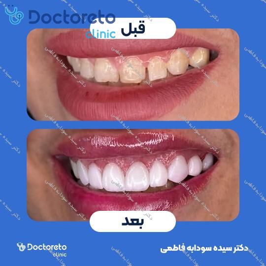لمینت دندان (هر واحد)⬅️ دکتر سیده سودابه فاطمی در مشهد 1