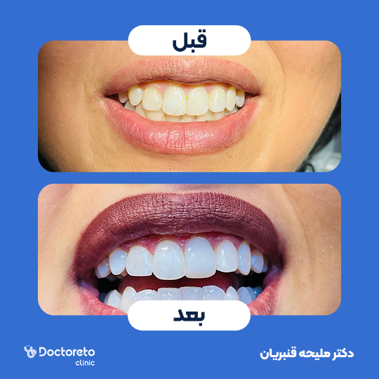 بلیچینگ دندان (سفید کردن دندان) دکتر ملیحه قنبریان در شیراز 1