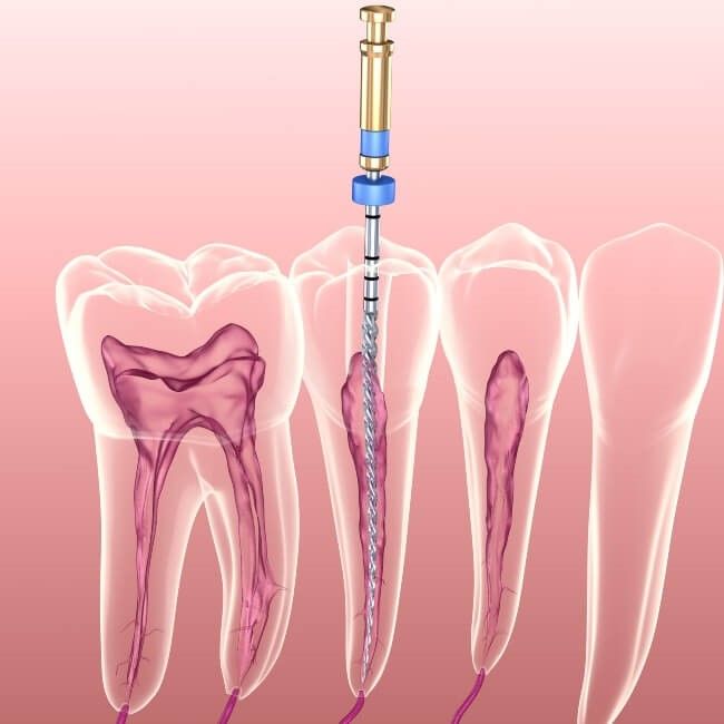 عصب کشی دندان⬅️ دکتر زهرا قدیری در اصفهان 1